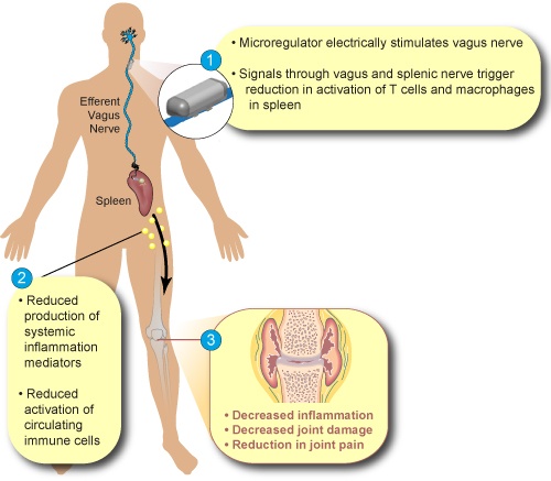 SetPoint-Medical-nerver-stimulation.jpg