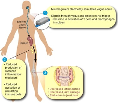 SetPoint-Medical-nerver-stimulation